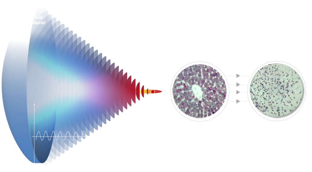 hifu-technology